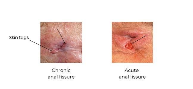 Fissure in Ano