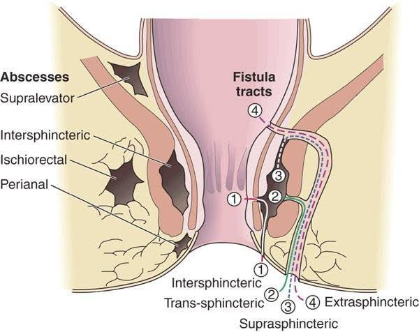 Fistula in Ano