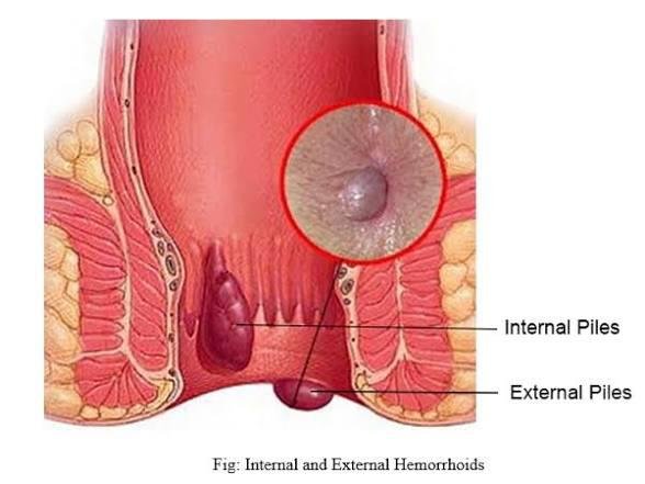 Piles (Hemorrhoids)